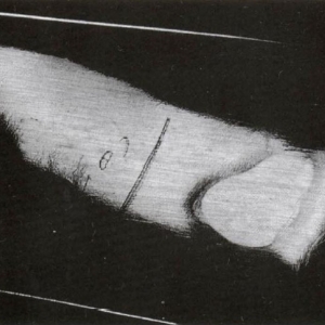 壓鑄件中波紋狀和湖狀痕跡的產生原因及解決方案